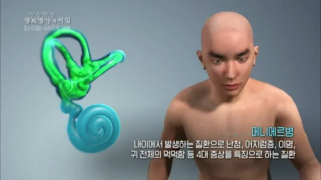 메니에르병, 어지럼·이명·귀 먹먹함이 함께 올 수 있습니다 — 출처: KBS 1TV 「생로병사의 비밀」