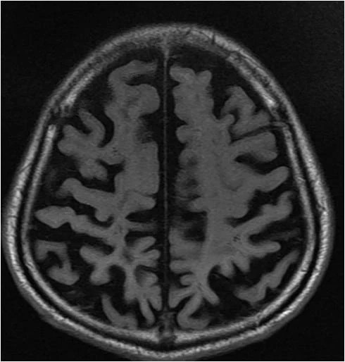 진행된 알츠하이머 치매 — 출처: 같은 높이에서 찍은 뇌 MRI — 왼쪽 정상 · 오른쪽 진행된 알츠하이머 치매
