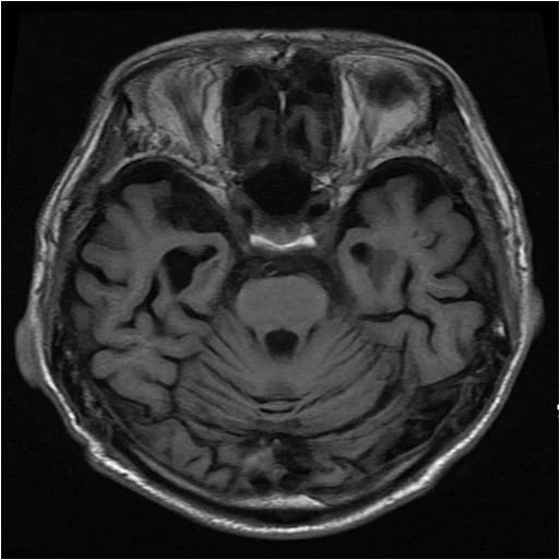 진행된 알츠하이머 치매 — 출처: 같은 촬영 조건에서 비교한 뇌 MRI — 왼쪽부터 정상 · 혈관성 치매 · 진행된 알츠하이머 치매