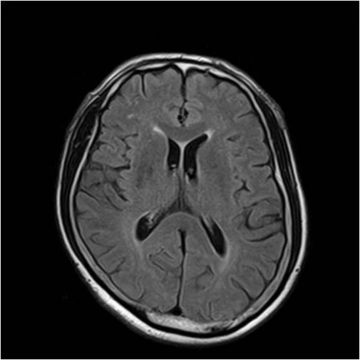 정상 — 출처: 같은 높이에서 찍은 뇌 MRI — 왼쪽 정상 · 오른쪽 진행된 알츠하이머 치매