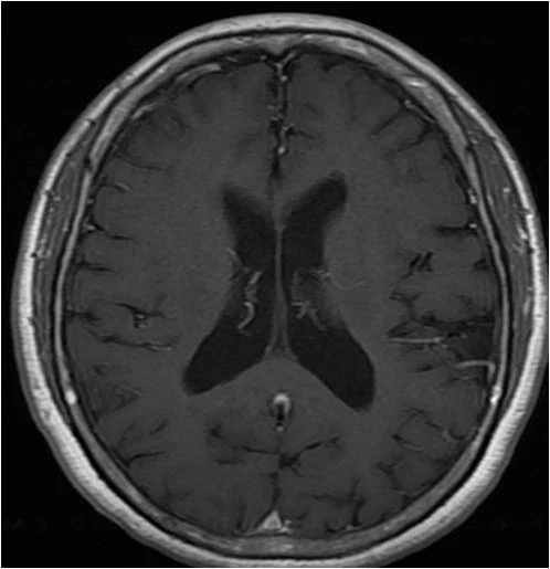 정상 — 출처: 같은 촬영 조건에서 비교한 뇌 MRI — 왼쪽부터 정상 · 혈관성 치매 · 진행된 알츠하이머 치매