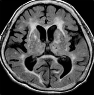 혈관성 치매 — 출처: 같은 촬영 조건에서 비교한 뇌 MRI — 왼쪽부터 정상 · 혈관성 치매 · 진행된 알츠하이머 치매