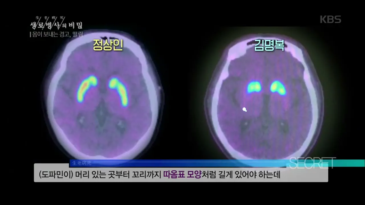 손떨림, 모두 파킨슨병이 아닙니다 — 출처: KBS 1TV 「생로병사의 비밀」 · 자료 대한신경과학회