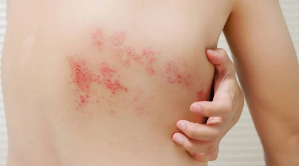 대상포진은 피부병이 아니고 신경병입니다 — 출처: 대상포진 피부 발진 — 한쪽 피부분절을 따라 띠 모양으로 나타난다
